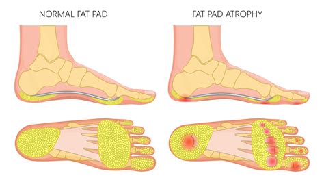 Pads Of Fat