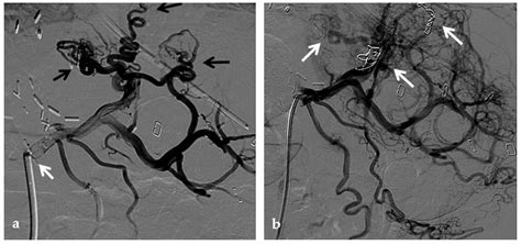 The Role of Imaging in Portal Vein Thrombosis: From the Diagnosis to ...