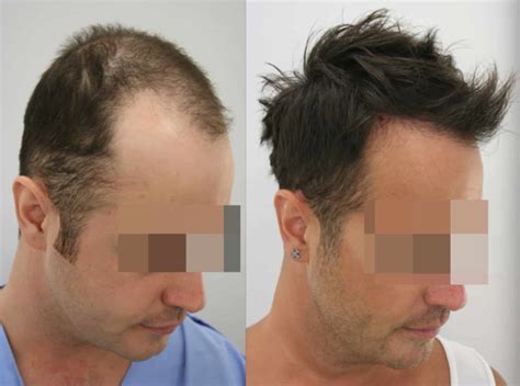 Hair Transplant Turkey from £1199 | Free Consultation in UK - GetHair