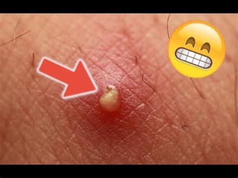 Image result for Large Pimples Exploding