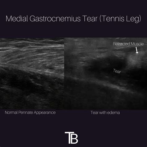Gastrocnemius Muscle Tear
