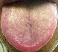舌を診る: 毎日が漢方（新潟の漢方医院のブログ）