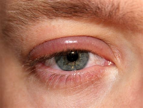 Bildergebnis für blepharitis hausmittel