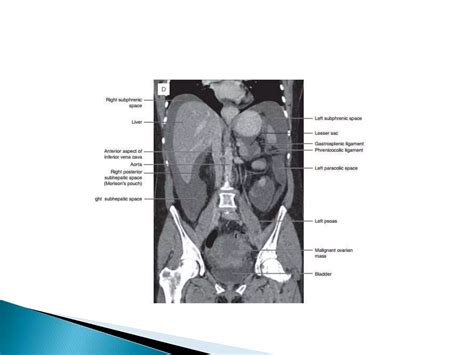 Imaging anatomy of peritoneum | PPTX