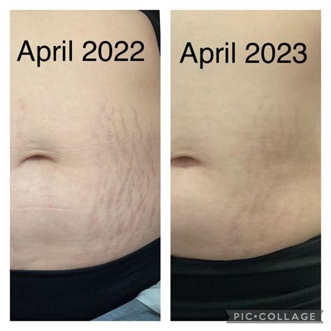 Tretinoin Stretch Marks