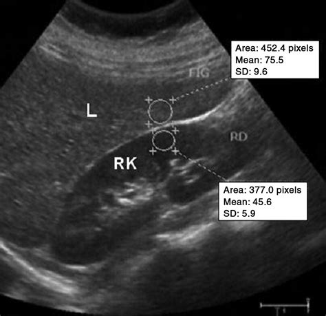 Computer-Assisted Ultrasound Analysis of Liver Echogenicity in Obese and Normal-Weight Children ...