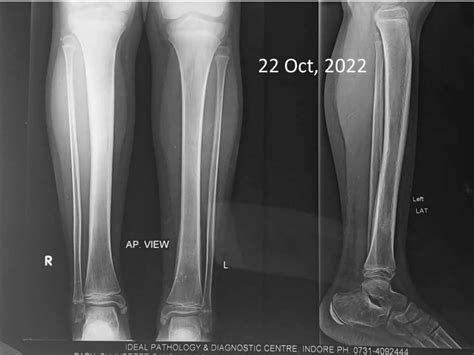 Chronic Recurrent Multifocal Osteomyelitis - a care report.pptx