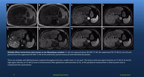Liver lesions on mri | PDF