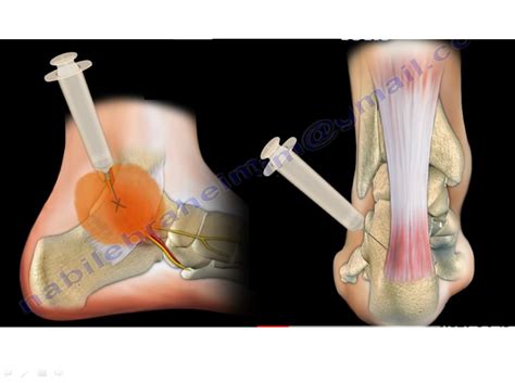 Image result for Ankle Anterolateral Approach Injection