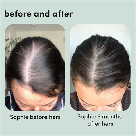 Minoxidil For Women Before And After