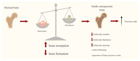 Difference Between Bone Formation And Bone Resorption at Timothy ...