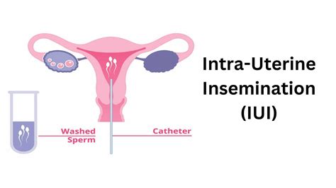 IVF vs IUI: 10 Must Know Differences - Aastha Fertility Center