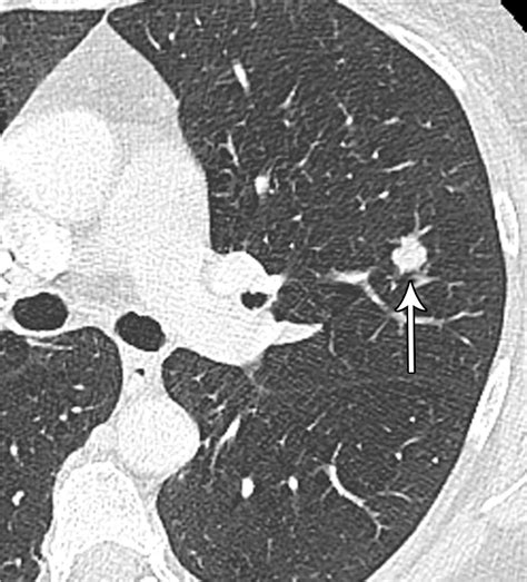 Updated Fleischner Society Guidelines for Managing Incidental Pulmonary ...