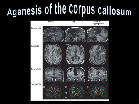 PPT - Agenesis of the Corpus Callosum: A Review of Diagnostic ...