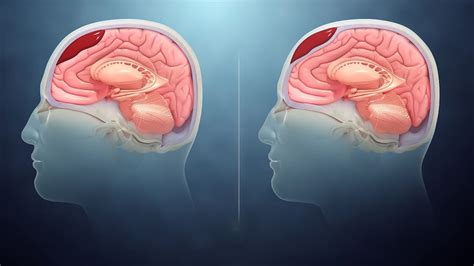 Intracranial Hematoma: इंट्राक्रेनियल हेमाटोमा क्या है? कारण, लक्षण ...
