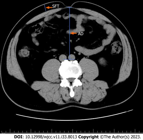Subcutaneous fat thickness and abdominal depth are risk factors for surgical site infection ...