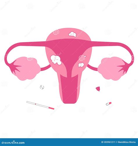 Fibroid Cartoons, Illustrations & Vector Stock Images - 379 Pictures to download from ...