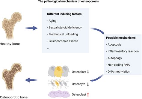 Calcium Phosphate Osteoporosis at Robert Bence blog