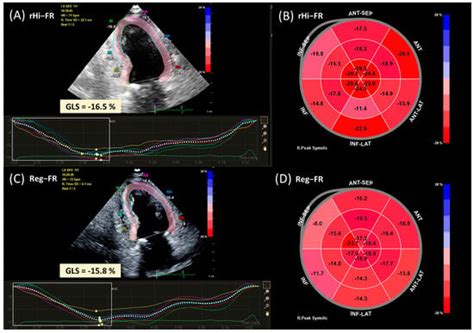 Speckle-Tracking Echocardiography with Novel Imaging Technique of ...
