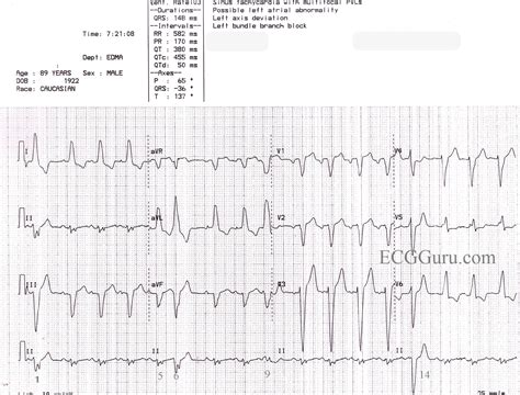 Image result for PVC ECG Reading
