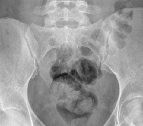 Sacroiliac Joint Fracture X Ray at Donald Pray blog