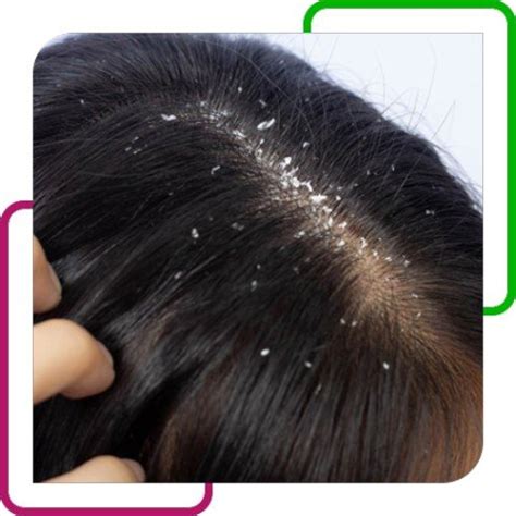 Dandruff, Seborrheic Capitis – Regrow