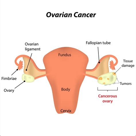 Ovarian Cancer: Causes, Risk Factors, Symptoms, Treatment