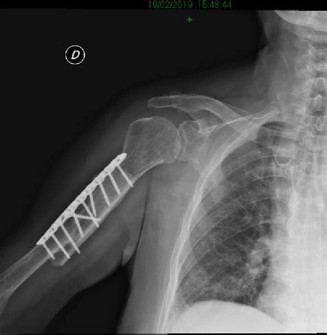 5 months postoperative X-ray evaluation: optimal bone healing | Download Scientific Diagram