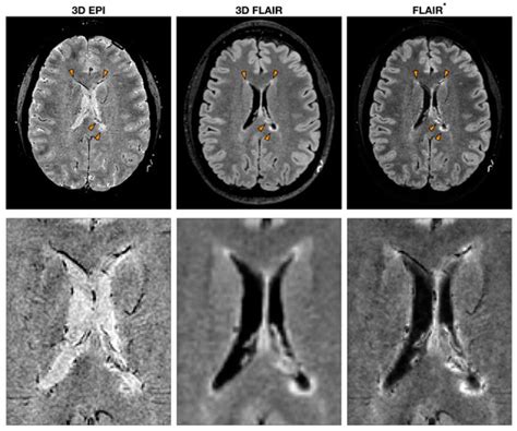 Central Vein Sign in MS | Encyclopedia MDPI