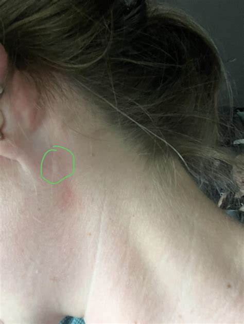 Lump Behind Ear Veins at Jacob Mauldin blog