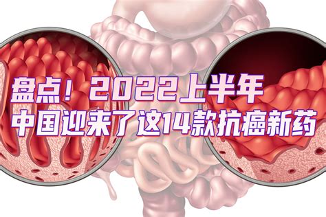 盘点！2022上半年中国迎来了这14款抗癌新药_凤凰网视频_凤凰网