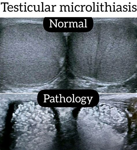Microlithiasis In Testis