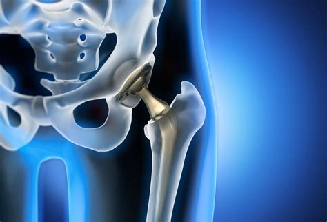 Hip Replacement Implant Loosening Symptoms