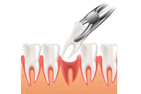 Extract Tooth 的图像结果