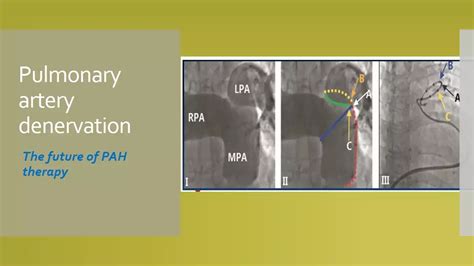 Pulmonary artery denervation shows promise for group I PAH patients ...