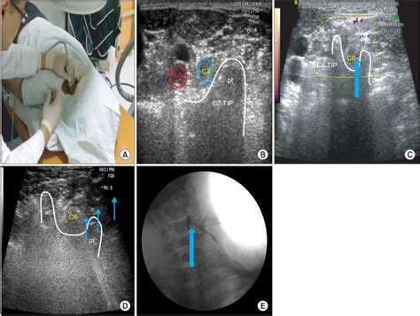 Image result for Selective Nerve Root Block Contrast Spread Pattern