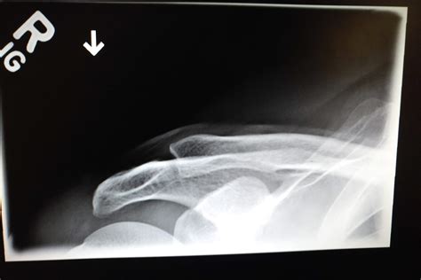 Osteolysis of Distal Clavicle | Sport Med School