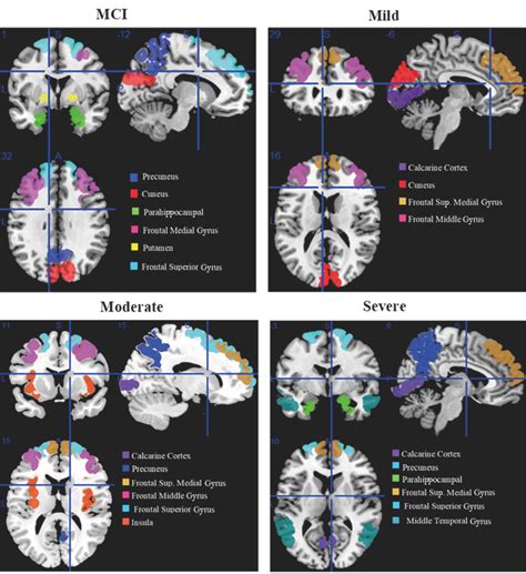 Voxel Extraction and Multiclass Classification of Identified Brain ...