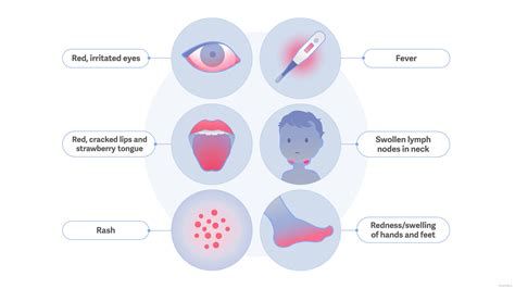 Clinical Overview of Kawasaki Disease | Kawasaki Disease | CDC