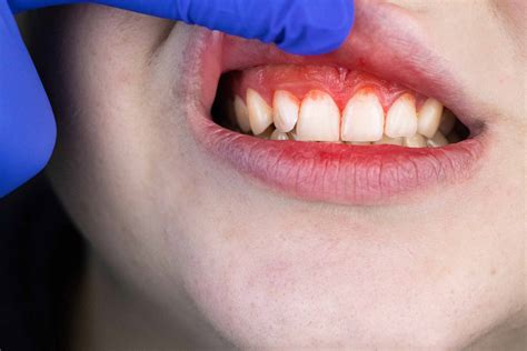 Periodontal Disease or Gum Disease – what is it and how do we treat it? | Gum Disease Treatment ...
