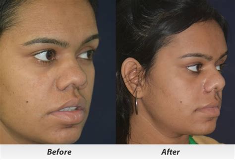 Broad Nose Correction | Cosmetic Rhinoplasty India