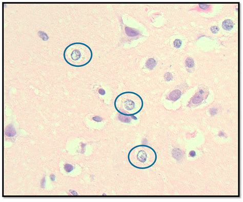 Suspected Mitochondrial Dysfunction and Complex Pathophysiology in ...