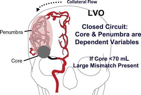 Lvo Medical Abbreviation