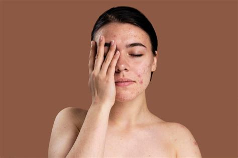 Acne Problem For Skin: एक्ने प्रॉब्लम को कम करने के लिए लगाएं एलोवेरा ...