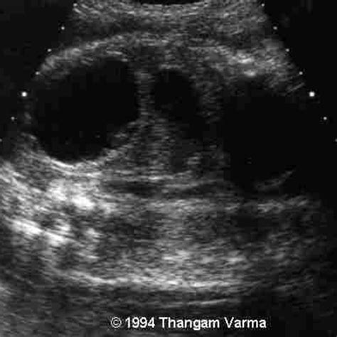📃 Ovary, cyst