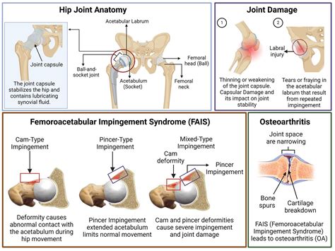 Outcomes and complications of hip arthroscopy for femoroacetabular ...