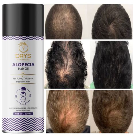 7days Alopecia Hair oil with Ginger | Anti-Hair Fall Hair Oil | (100 ml ...