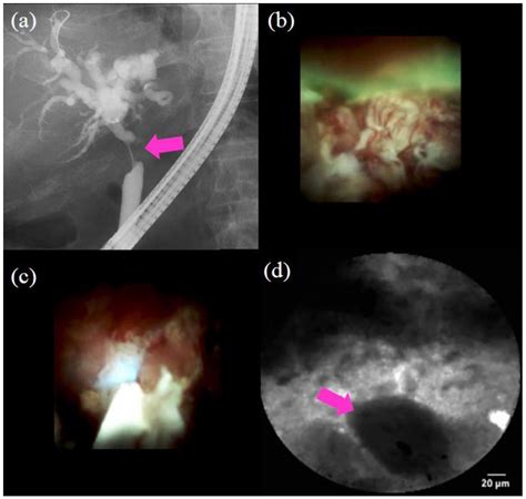 Diagnostic Process Using Endoscopy for Biliary Strictures: A Narrative ...