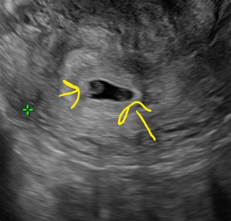 Potentially 2 yolk sacs? | BabyCenter