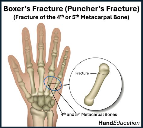 Boxer’s Fracture - Hand Education